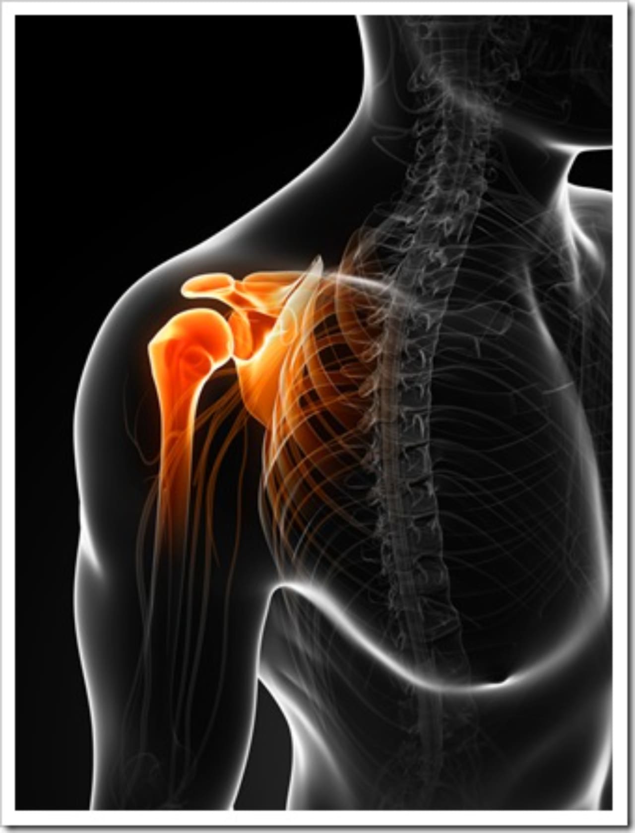 Frozen Shoulder Atlanta GA Neck Pain