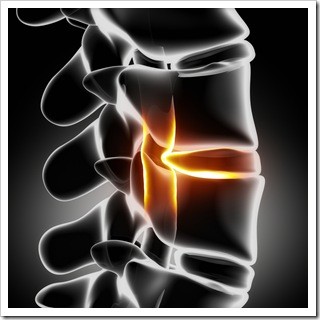 Slipped Disc Atlanta GA